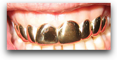 Goldteeth