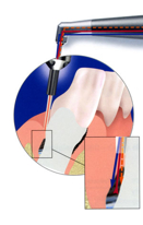 periolaser