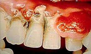 Patients: Floss Your $%#*^@# Teeth!